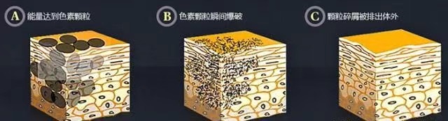洗纹身原理-1.jpg