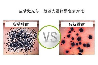 洗纹身原理-3.jpeg