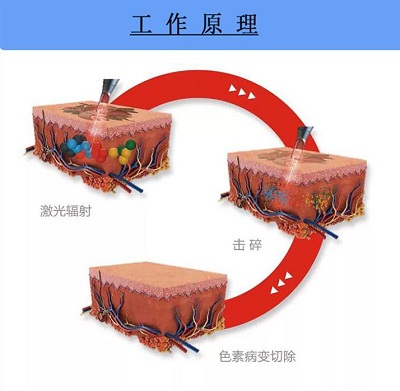 洗纹身原理-5.jpg