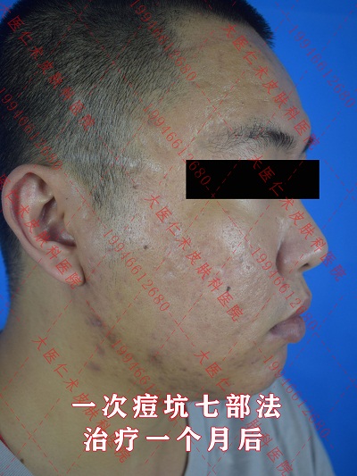 痘坑后2.jpg