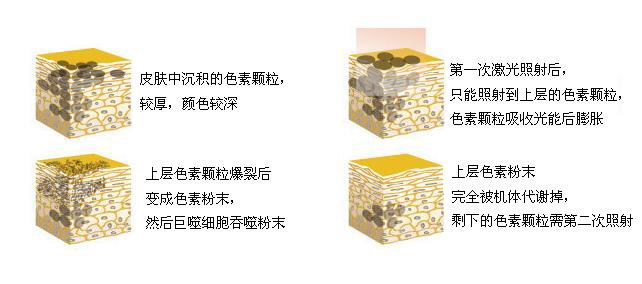 洗纹身原理-6.jpg