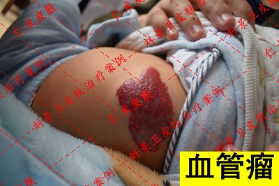 血管瘤.jpg