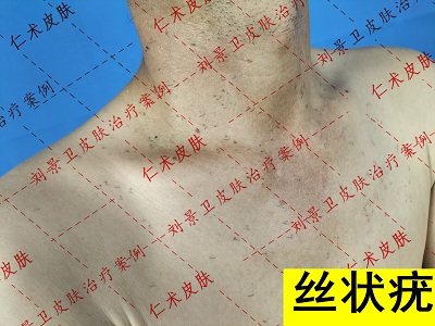 丝状疣2.jpg
