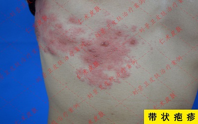 带状疱疹.jpg