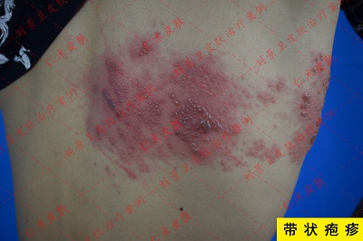 带状疱疹 (2).jpg