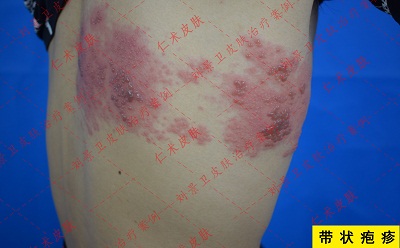 带状疱疹 (3).jpg