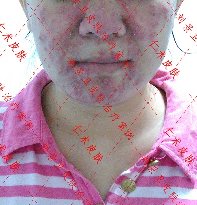 激素皮炎2.jpg