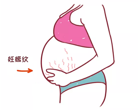 妊娠纹.png