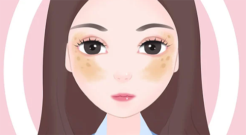黄褐斑.png
