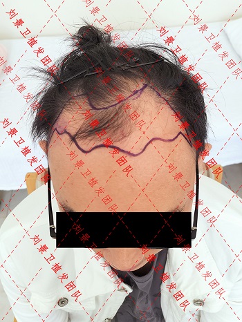 发际线植发男.jpg