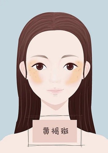 黄褐斑2.webp.jpg