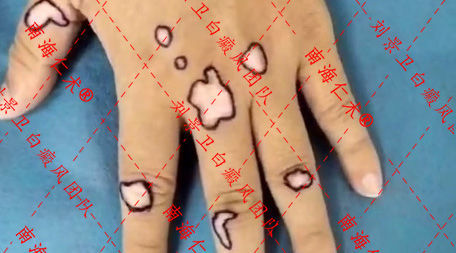指端白癜风.jpg