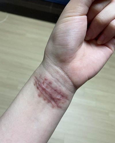 疤痕手腕.jpg