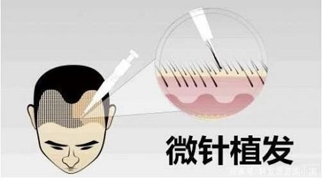 植发3.jpg