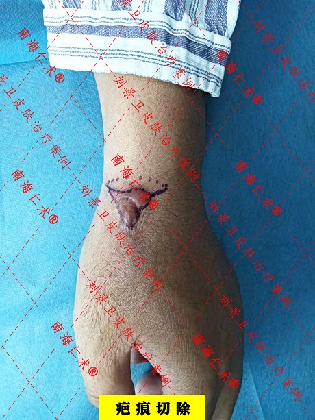 手部疤痕切除.jpg