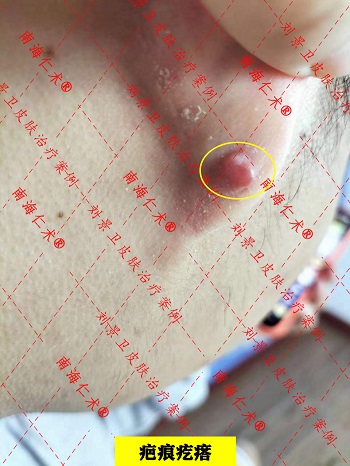 疤痕疙瘩1.jpg
