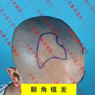 额角植发前1.jpg