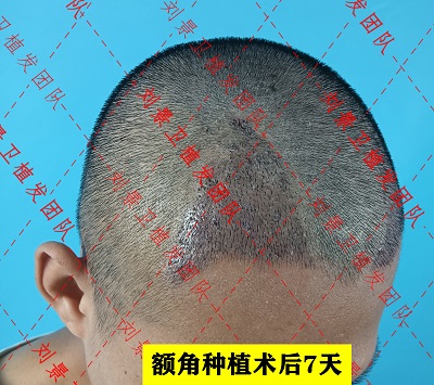 额角种植术后7天1.2.jpg