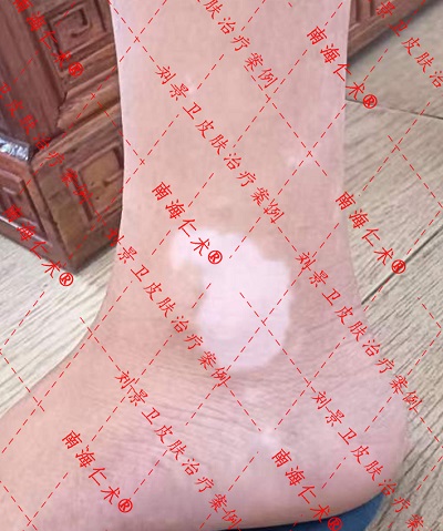 白斑4.jpg