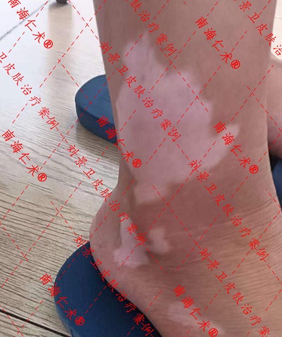 白斑2.jpg