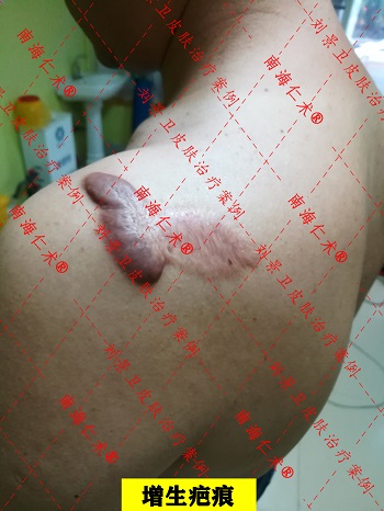 增生疤痕.jpg