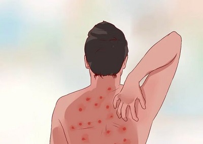 荨麻疹.jpg