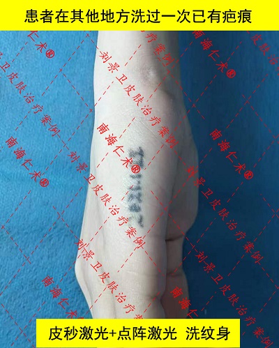 纹身疤痕手部1.jpg