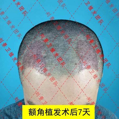 额角植发术后1.jpg