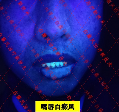 嘴唇白癜风.jpg