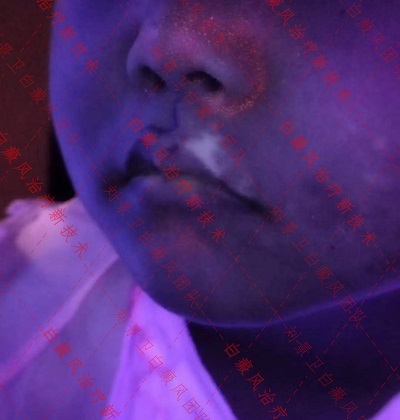 儿童嘴唇白癜风.jpg