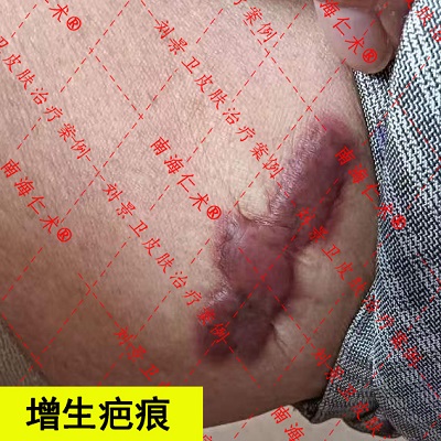 大腿增生疤.jpg