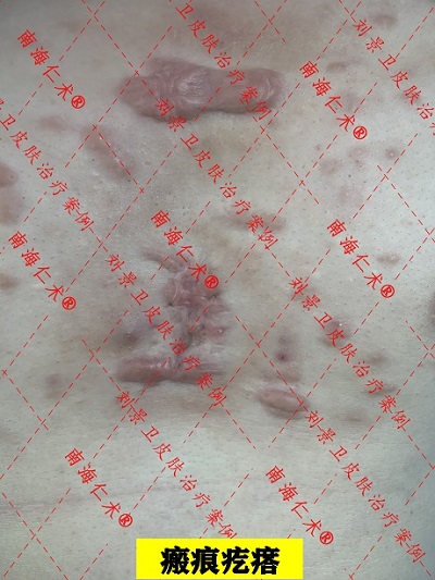 瘢痕疙瘩.jpg