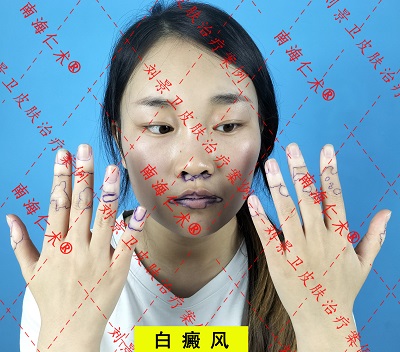 白癜风模特1.jpg