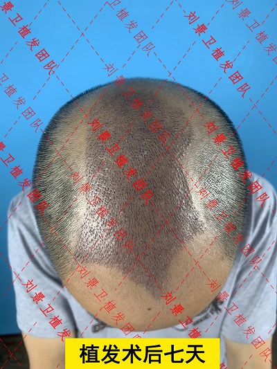 头顶加密术后7天.jpg