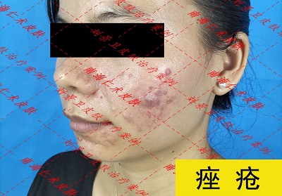 痤疮 (9).jpg