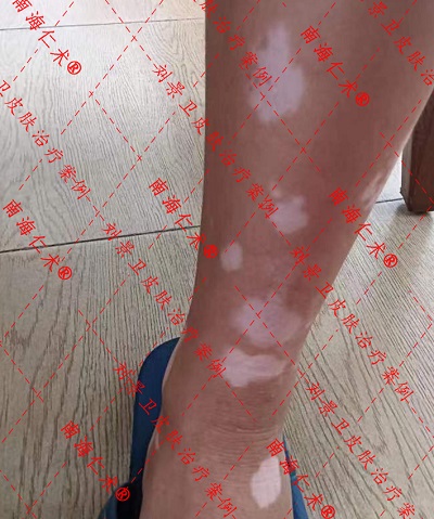 白斑5.jpg