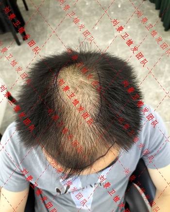 脱发植发.jpg
