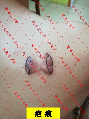 疤痕切除.jpg