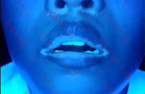 海口仁术白癜风.jpg