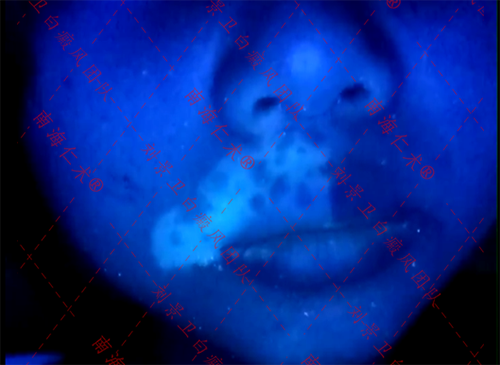 海口仁术白癜风.png