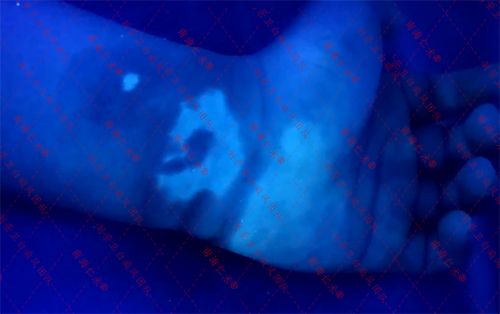 海口仁术白癜风.png