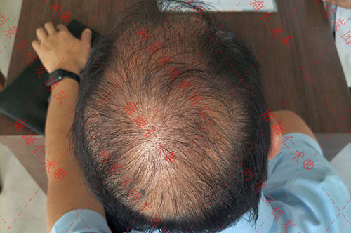 海南专业植发医院：植发对老年人脱发有没有效果呢？