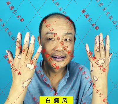 白癜风模特.jpg