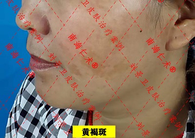 黄褐斑.jpg