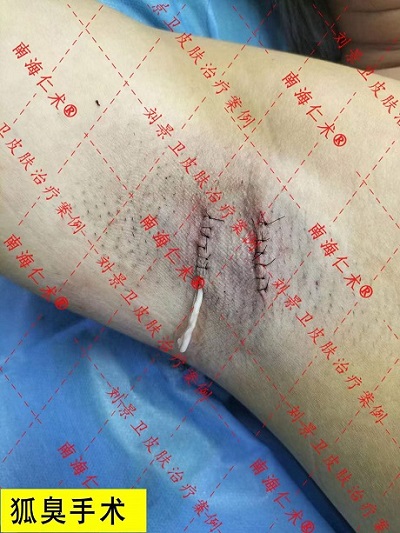 狐臭手术.jpg