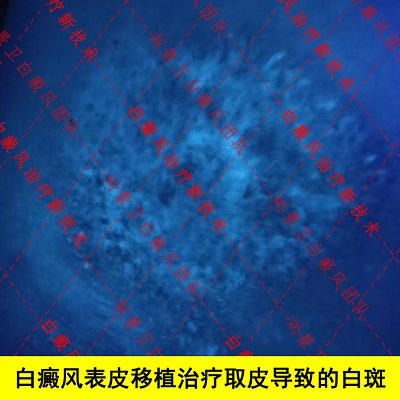 表皮移植后遗症.jpg