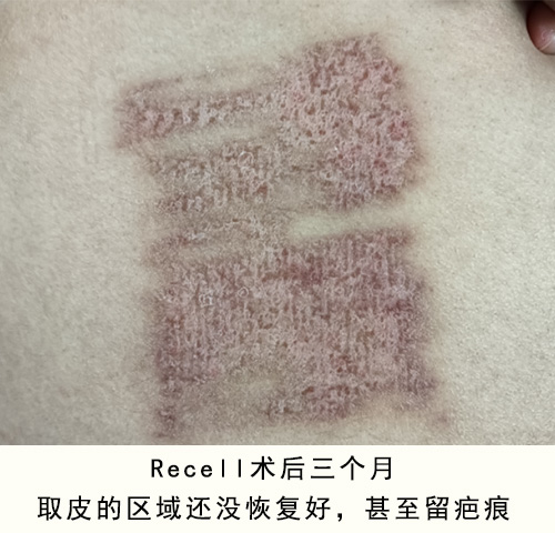 术后2个多月.jpg