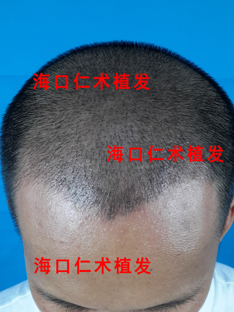 植发.png