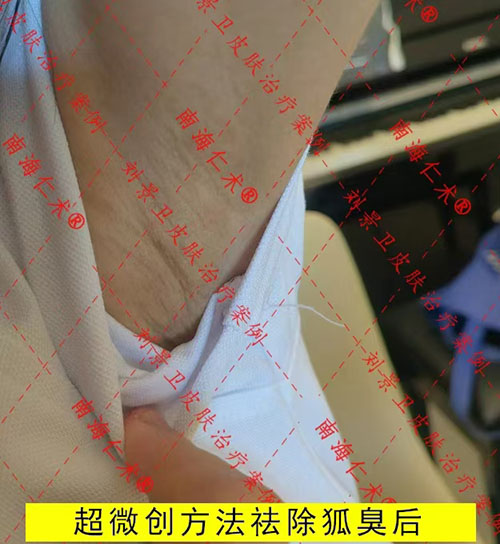 狐臭微创手术.jpg