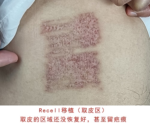 术后2个多月.jpg